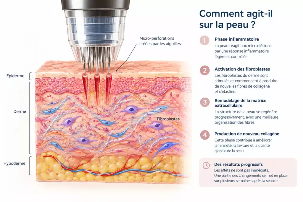 schéma du microneedling : micro-perforations dans l'épiderme et le derme